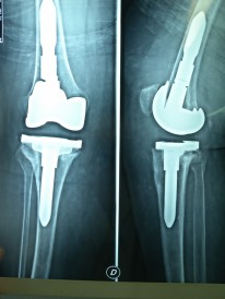 Immagine radiografica di protesi di ginocchio da revisione