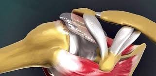 Immagine schematica/anatomica della funzione del Balooon Orthospacer nell’arco del movimento della spalla