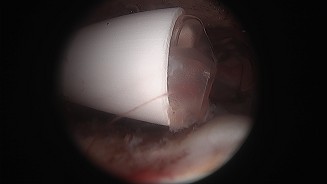 immagine di fase artroscopica di inserimento del Baloon Orthospacer