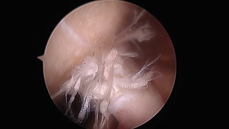 Lesione del CLB (capo lungo bicipite) durante trattamento artroscopico con impianto di Baloon Orthospacer
