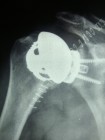Protesi di spalla gleno-omerale mini-invasiva